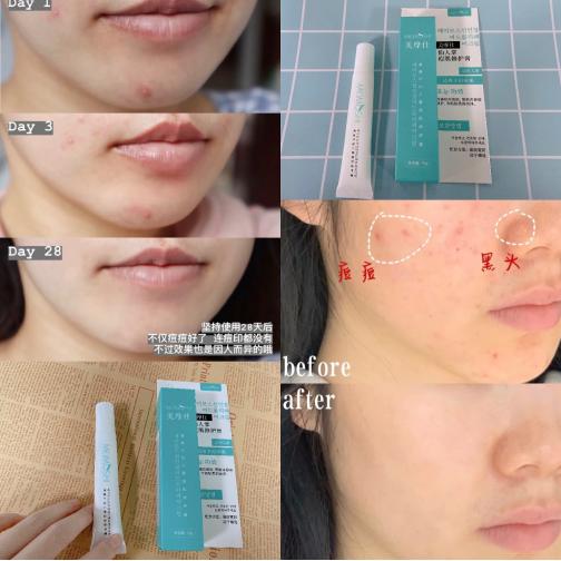 美摩仕祛痘膏效果好吗,美摩仕祛痘效果好吗