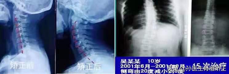 脊骨神经医学(美式脊椎矫正)精品课程