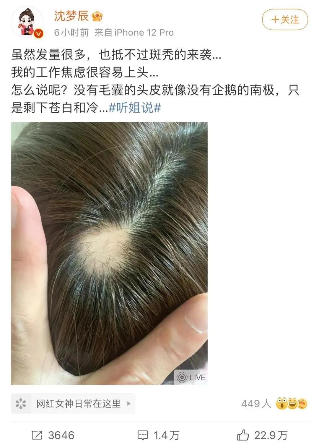 美女主持人突然上热搜，网友纷纷晒同款！脱发原来是毛囊“休息”了