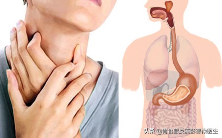32岁男子反酸烧心,反流性食管炎吞咽疼痛有多疼