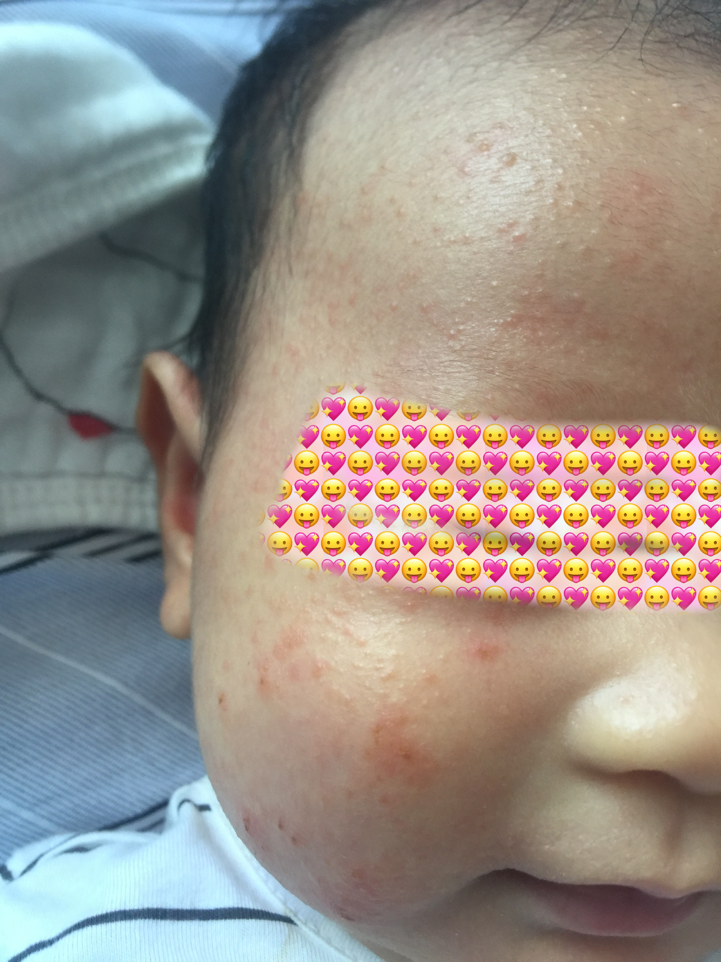 宝宝湿疹有多难分享治愈经验,经过实践的治疗宝宝湿疹方法大全