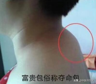 刮痧艾灸拔罐治富贵包,针灸拔罐艾灸能一块做吗