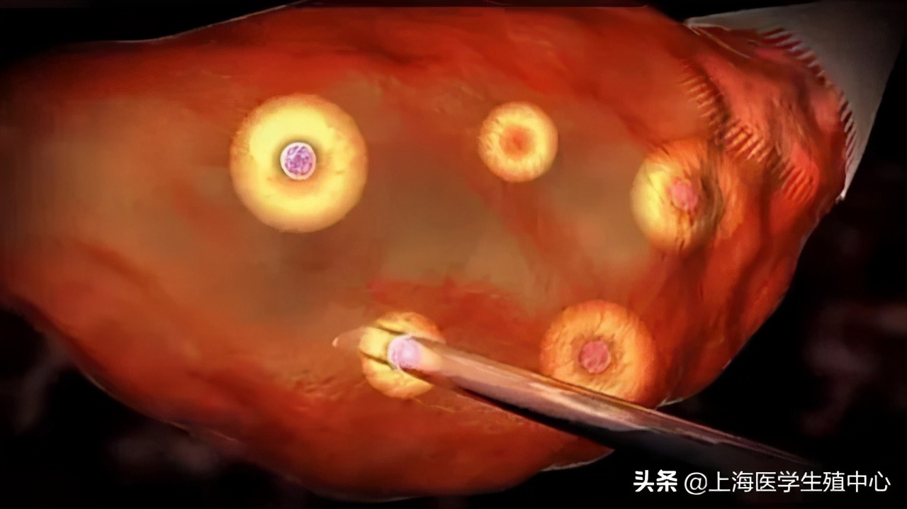 试管婴儿取完卵防止腹水,试管婴儿取完卵后注意哪些事项