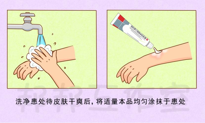 斑块状银屑病治疗方法,中度斑块银屑病怎么治疗最好