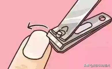怎么预防脚上的灰指甲传染手上,灰指甲传染率高及时处理避免扩散