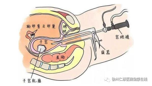 备孕撞上子宫肌瘤，妇科医生的第三只“眼”为患者解忧愁