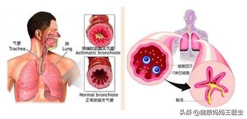 支气管炎吃什么消炎药最见效,治疗支气管炎用什么消炎药比较好