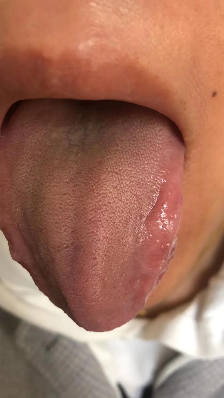 中药治疗多囊卵巢综合征案例,专治多囊卵巢闭经中成药