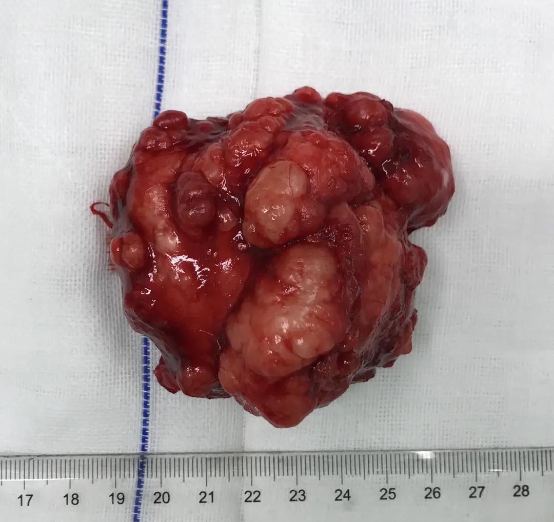 口腔肿瘤切除手术,口腔颌面外科肿瘤开颅手术