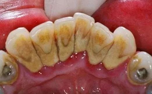 用冲牙器冲的牙很酸,用冲牙器后牙缝更大了