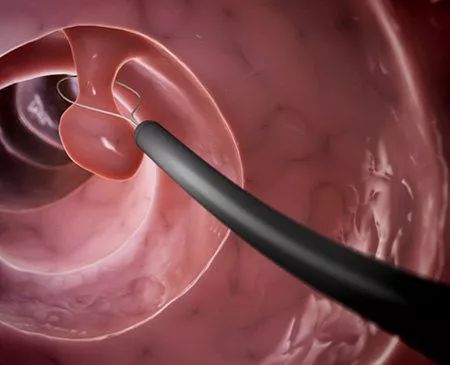 结肠癌是否可以预防,如何防结肠癌和直肠癌