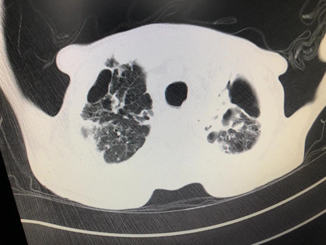 怀疑肺结核必须要做气管镜检查吗,痰里找到结核杆菌就说明肺结核吗