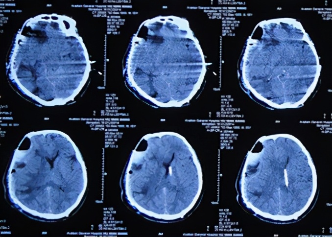 脑外伤开颅手术后脑积水,脑外伤手术后脑脊液鼻漏怎么治疗