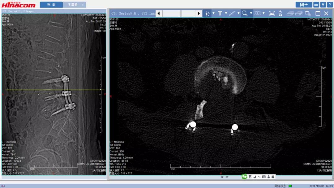 再也不用歪着身子走路了—区医院脊柱中心（骨二科）成功实施腰椎间盘摘除、椎间植骨融合钉棒内固定术