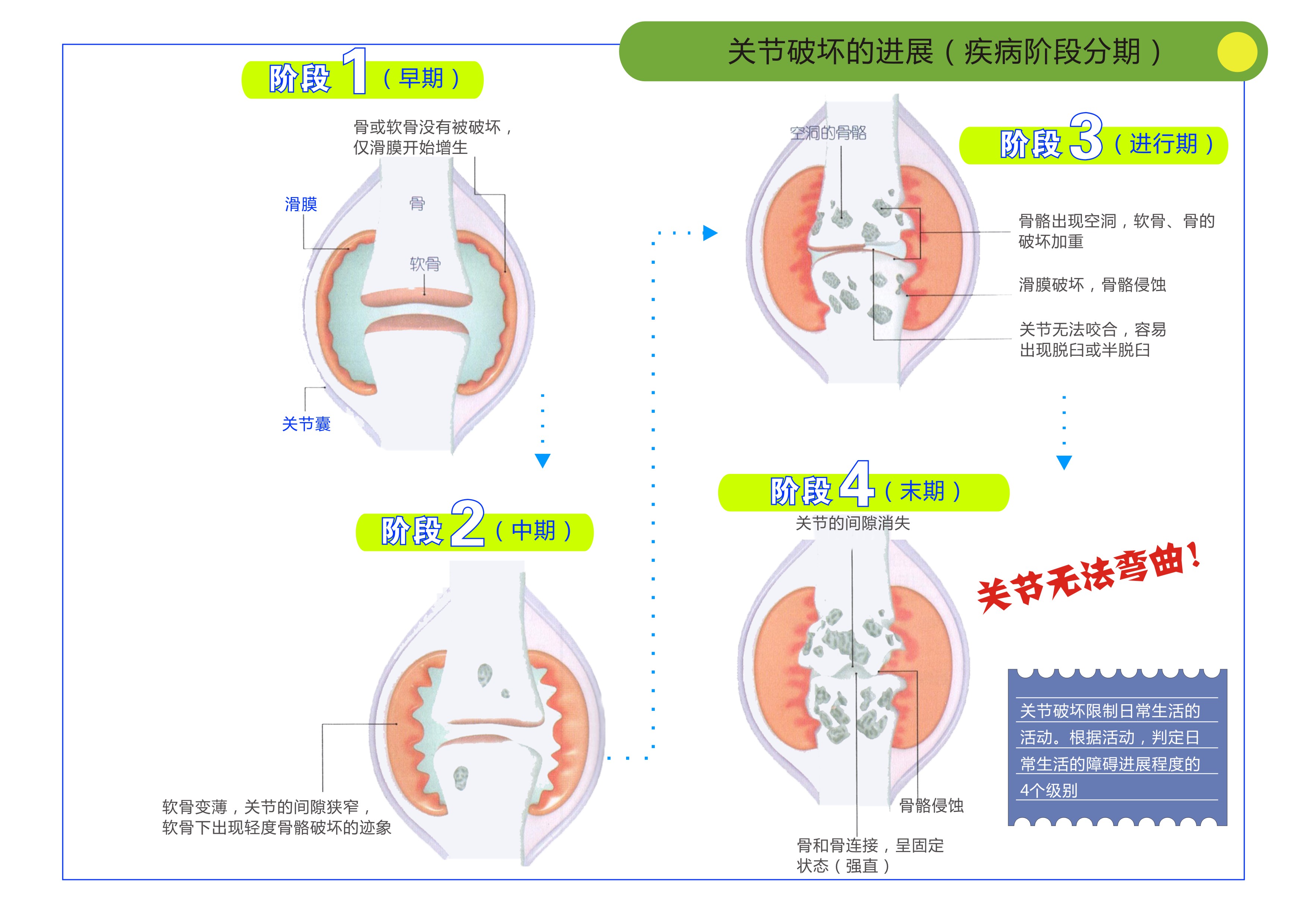 骨关节炎痛风和类风湿都有何症状,痛风关节严重畸形患者能活多久