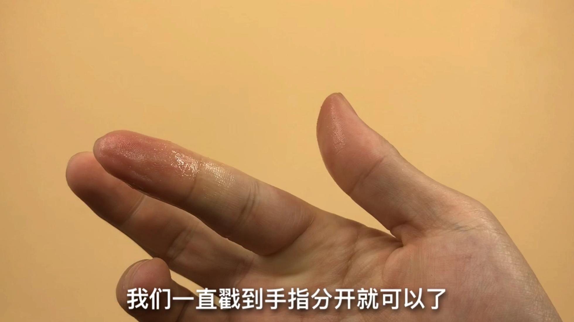 手指粘了502很久都好不了怎么办,502把手指和木棍粘在一起怎么办