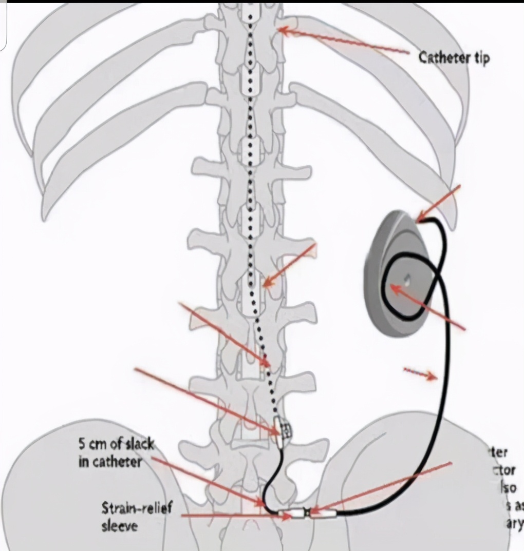 赶走疼痛，一身轻松！腰背痛，太原市中心医院疼痛科有妙招