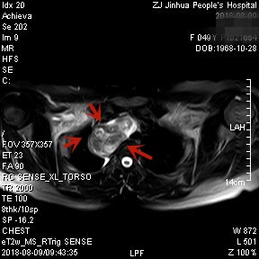 甲状腺肿瘤超大,胸骨后甲状腺肿病情是否很严重