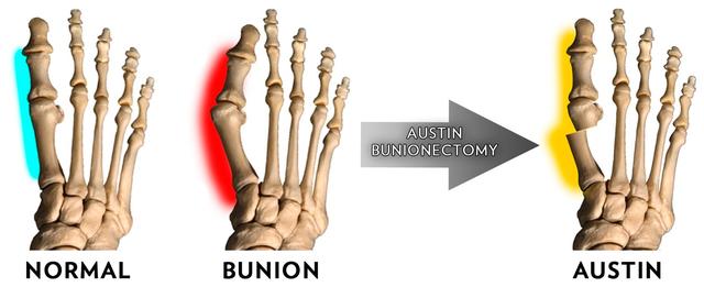 拇外翻大脚趾疼如何在家就能治,大脚拇指痛要警惕