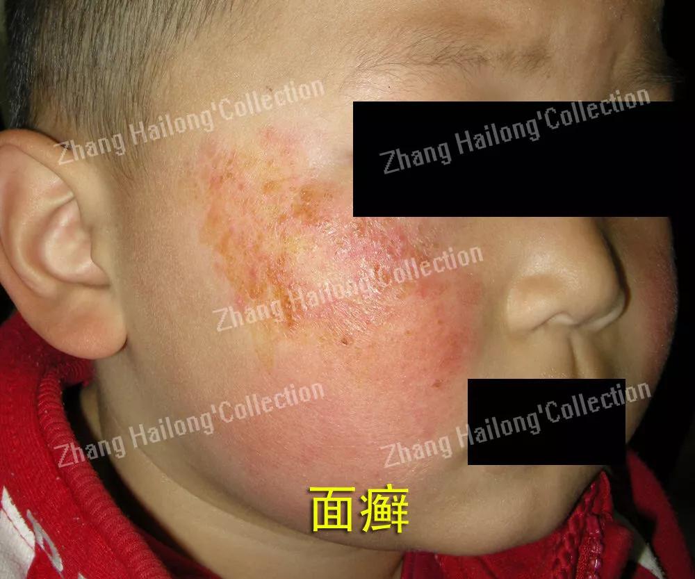 脸上长癣是怎么回事,12岁女孩脸上长癣