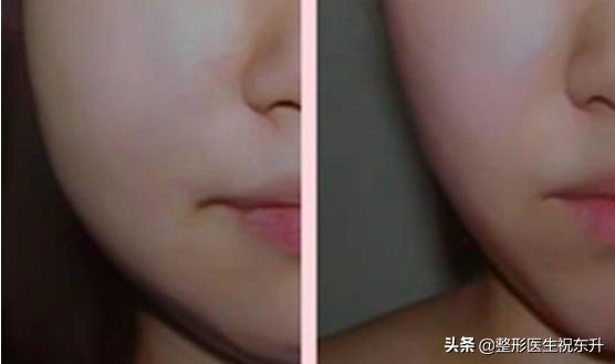 打瘦脸针会不会有什么危害,打瘦脸针有什么危害副作用