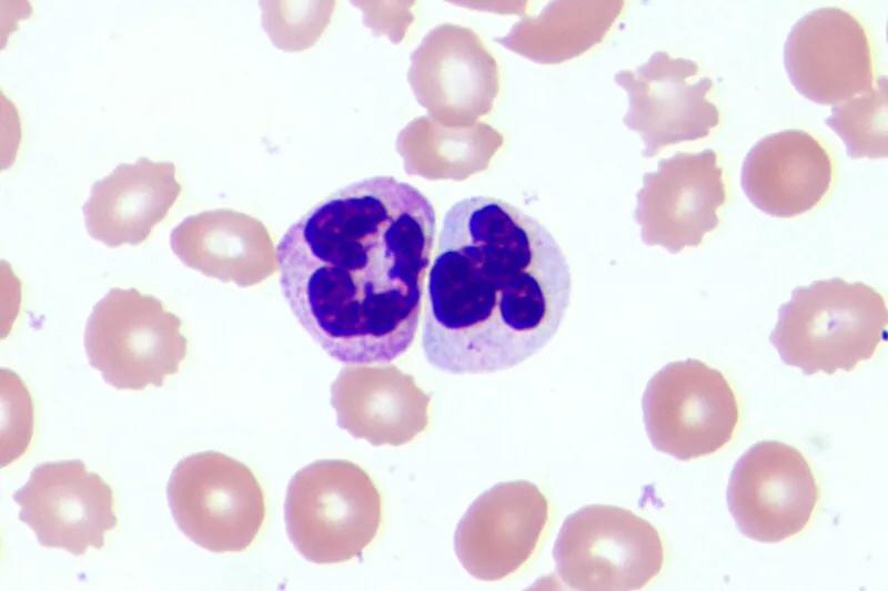 白细胞低医生说要做穿刺来检查,感冒发烧查血常规发现白细胞低