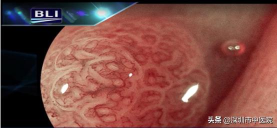 这个神器让肠道“违建”无处遁形！全国首套在深圳启用