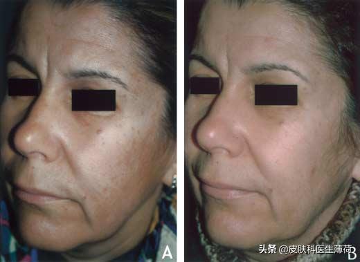 果酸换肤医生讲解,医生不会告诉你的秘密水杨酸