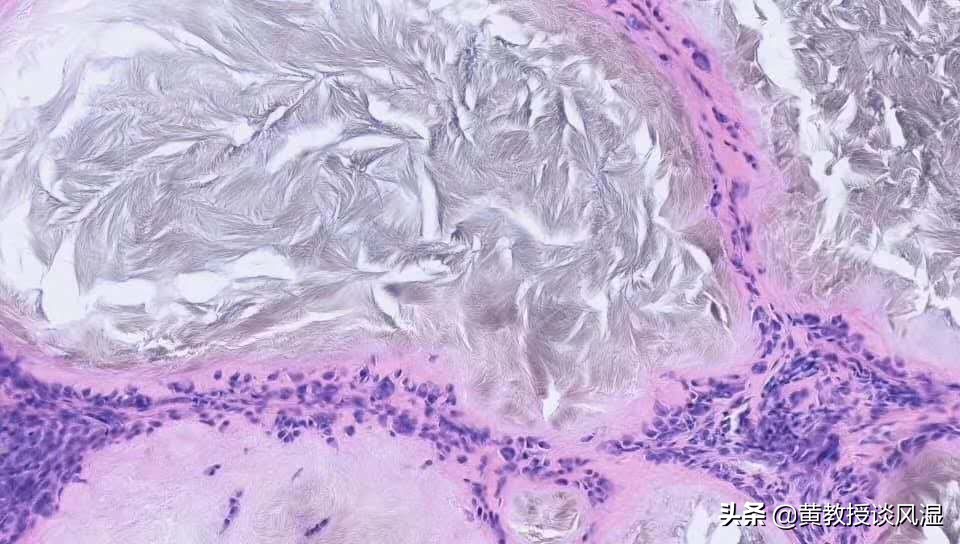 痛风的正确治疗方法,小鹅痛风的正确治疗方法