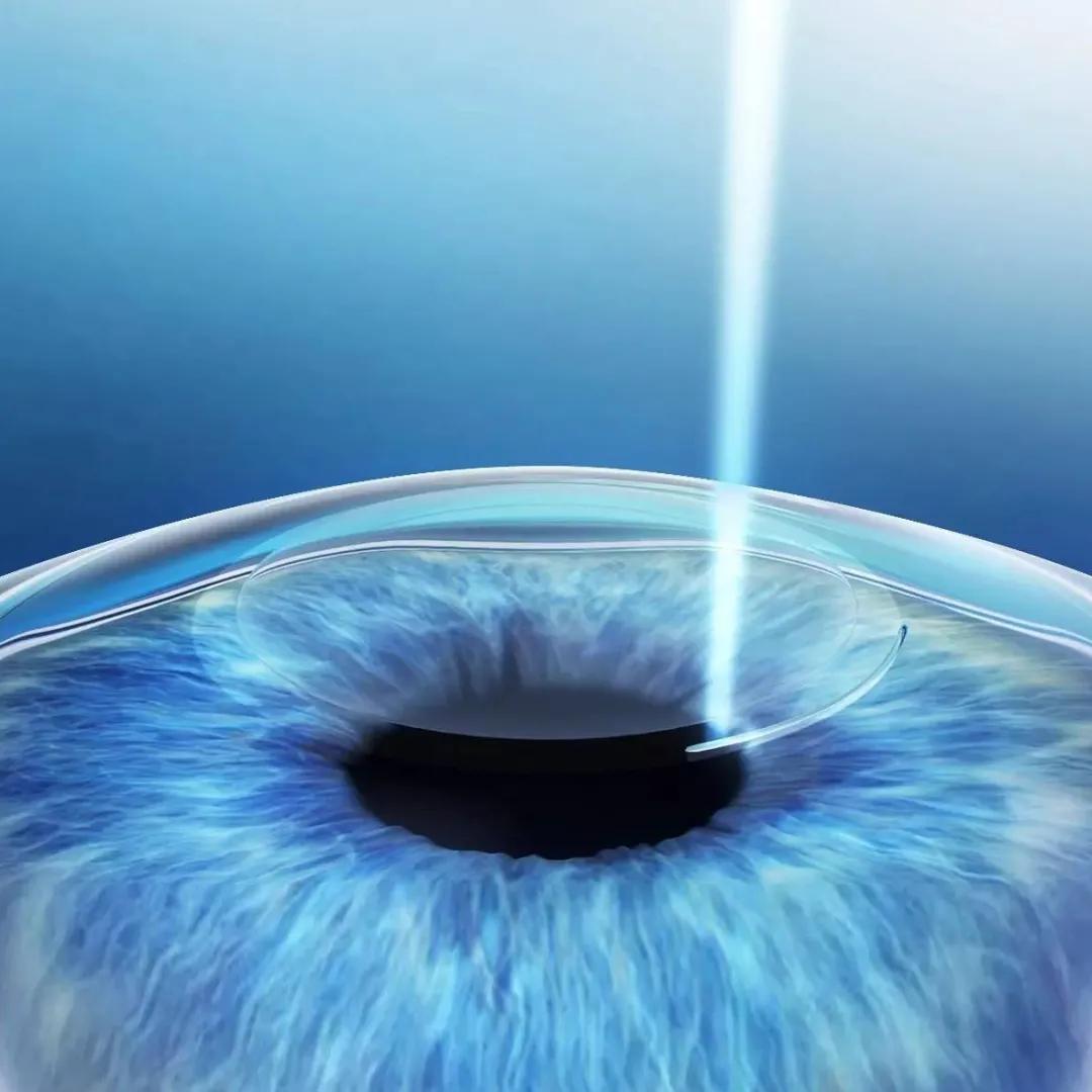 术前必须做的检查项目,近视手术的几种方式优缺点对比图