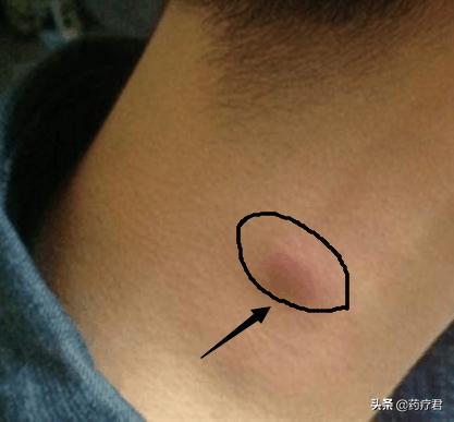 颈部有肿块怎么判断是不是肿瘤,男子脖子起疙瘩