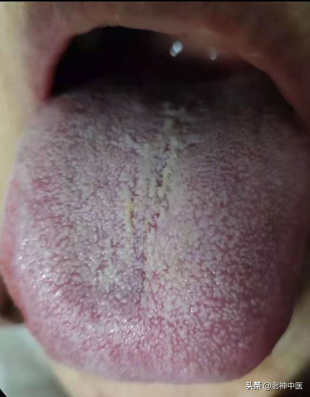 老年人止咳化痰有良方,治疗老人咳嗽肺炎的中药配方