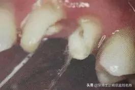 纤维桩修复费用,纤维桩修复全过程视频