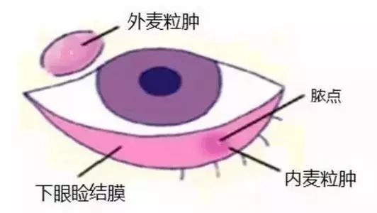 看不好的东西真的会长针眼吗,长针眼是看见不该看到的东西了吗