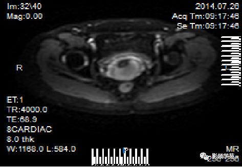 宫颈癌mri诊断,宫颈癌的mr扫描技术