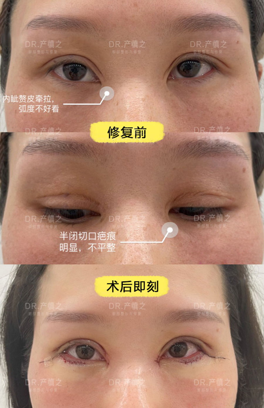 双眼皮疤痕凸起怎么回事,双眼皮两只眼睛疤痕不一样