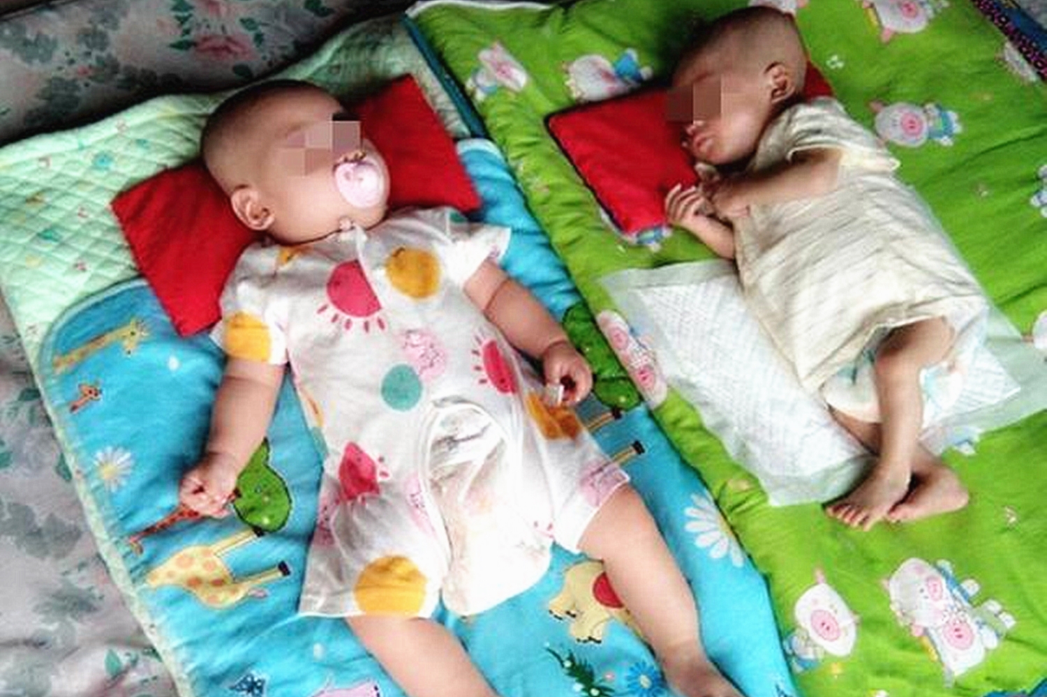 双胞胎输血综合症宝宝健康几率,双胎输血综合征28周早产宝宝