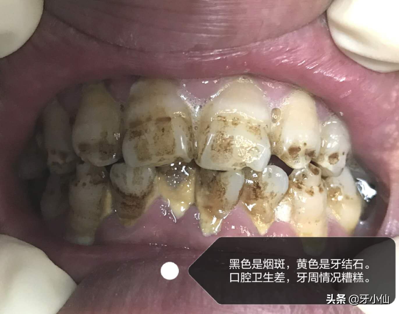 牙龈出血口臭跟牙齿不贴合,有个牙齿晃动牙龈出血口臭