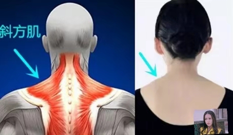 颈椎病肩膀厚怎么消除,颈椎导致的肩膀厚怎么改善