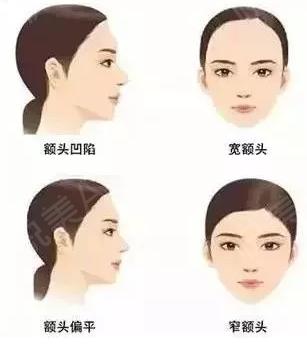 自体脂肪填额头部可以维持多久,自体脂肪填充需要了解什么