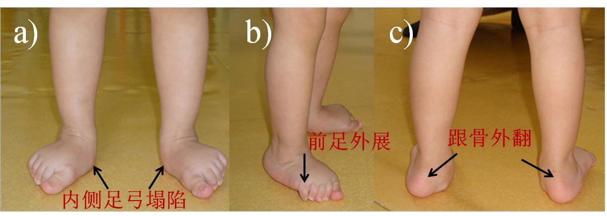 运动足外翻怎么矫正,运动引起脚大拇指外翻怎么矫正