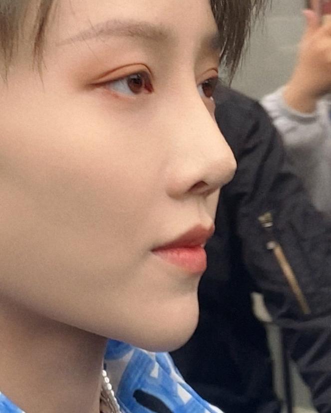 刘雨昕脸上有白点图片,刘雨昕脸上出现白点