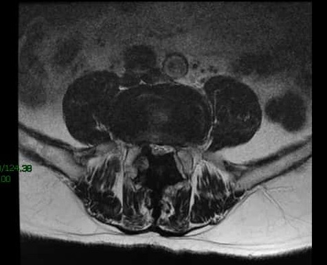 腰椎管狭窄症手术好么,腰椎管狭窄手术和保守治疗哪个好