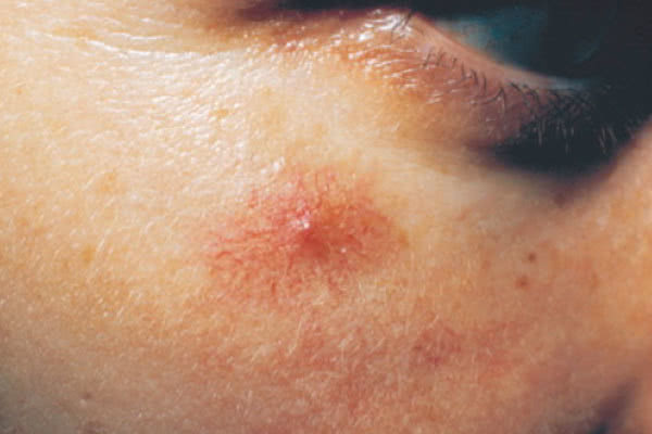 痣得皮肤癌的几率多大,皮肤上的痣癌变是什么症状