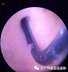 输卵管通而不畅通过腹腔镜咋检查,左侧输卵管通畅右侧通而不畅