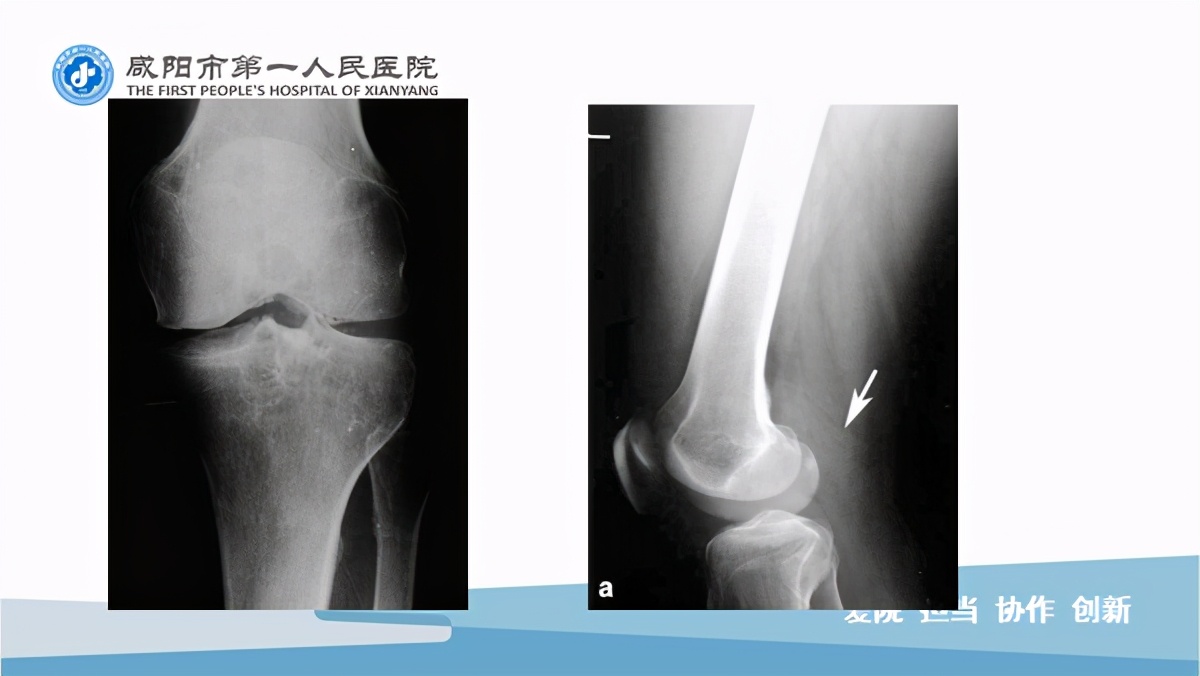 臭氧玻璃酸钠治疗膝关节炎怎么样,膝关节滑膜炎臭氧