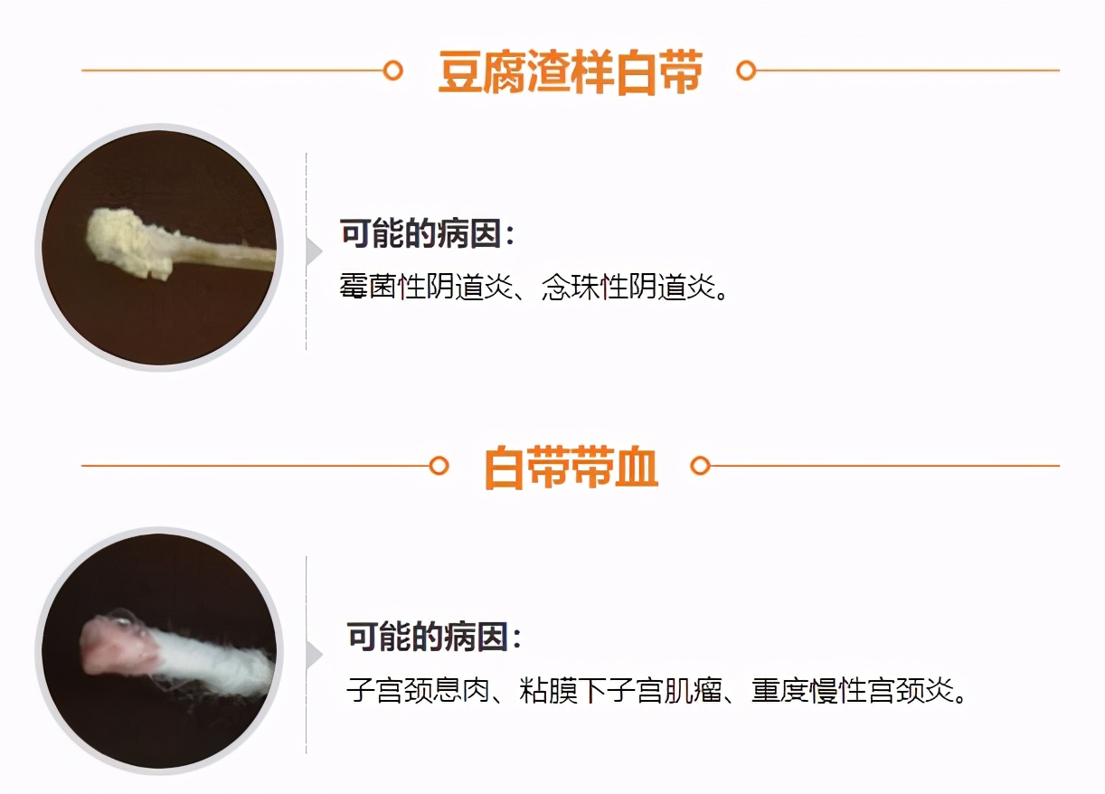 白带变黄或豆腐渣?这几种情况反映身体是否健康