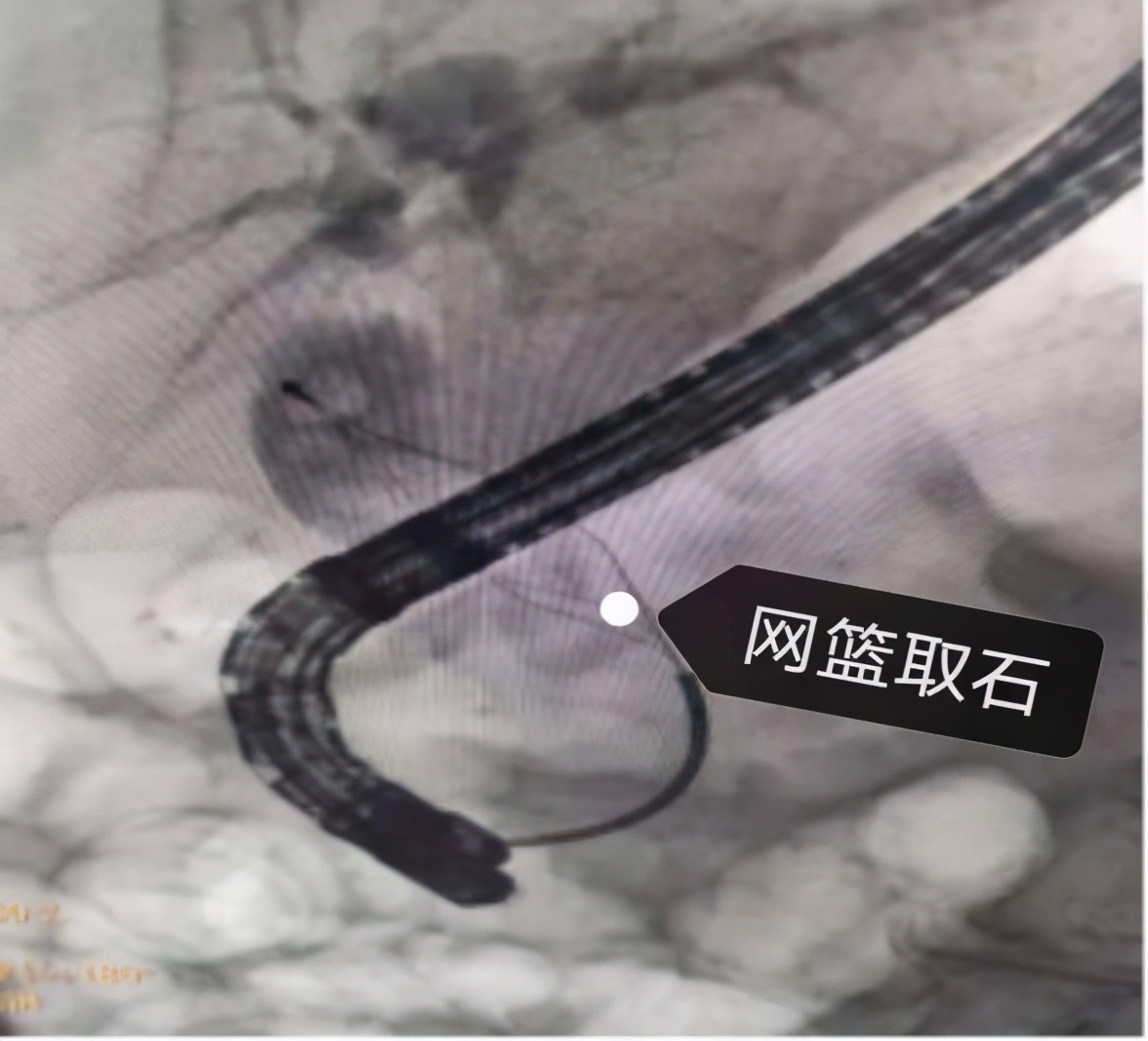 精益求精镜亦求净哈医大一院消化内科ERCP下取净胆管内2.5cm巨型结石