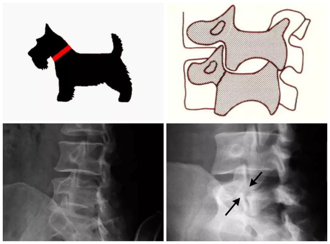 椎弓崩裂怎么知道是先天还是后天,椎弓崩裂的原理