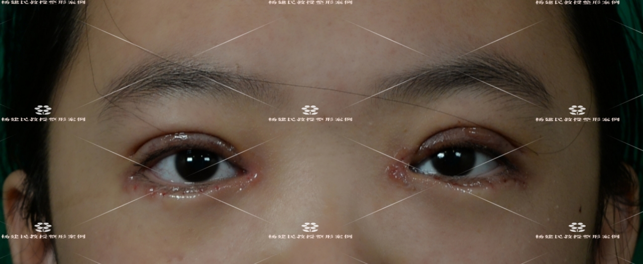 眼睑内翻倒睫治疗方法,老年人倒睫最快的治疗方法